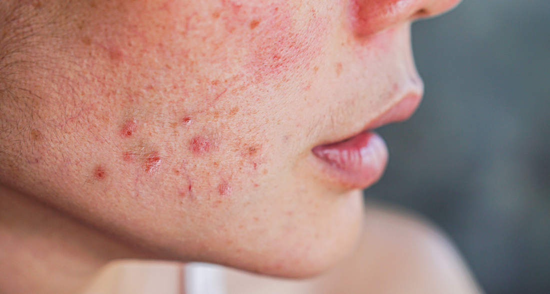 Can a Food Sensitivity Test Help my Acne?